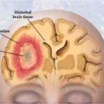 First in a two-part report  | Wireless radiation from cell phones causes health problems, say lawsuits